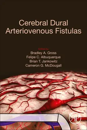 Gross / Albuquerque / Jankowitz |  Cerebral Dural Arteriovenous Fistulas | Buch |  Sack Fachmedien