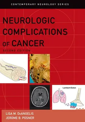 DeAngelis / Posner |  Neurologic Complications of Cancer | Buch |  Sack Fachmedien