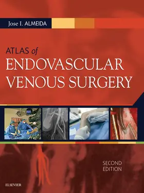 Almeida MD / Almeida |  Atlas of Endovascular Venous Surgery E-Book | eBook | Sack Fachmedien