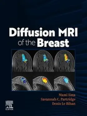 Iima / Partridge / Le Bihan |  DIFFUSION MRI OF THE BREAST, E-Book | eBook | Sack Fachmedien