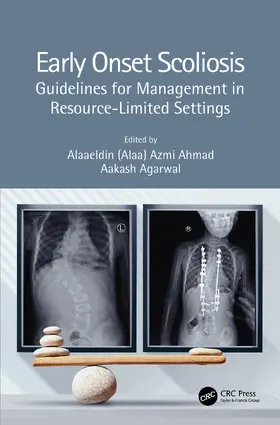 Ahmad / Agarwal |  Early Onset Scoliosis | Buch |  Sack Fachmedien