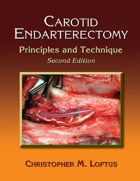 Loftus | Carotid Endarterectomy | Buch | 978-0-367-39033-4 | www.sack.de