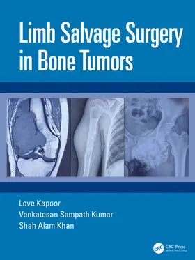 Kapoor / Khan / Kumar |  Limb Salvage Surgery in Bone Tumors | Buch |  Sack Fachmedien