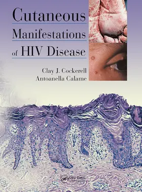 Calame / Cockerell |  Cutaneous Manifestations of HIV Disease | Buch |  Sack Fachmedien