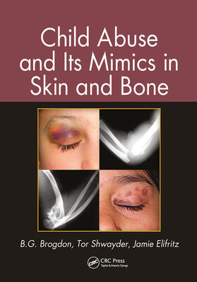 Brogdon / Shwayder / Elifritz | Child Abuse and its Mimics in Skin and Bone | Buch | 978-0-367-77818-7 | sack.de