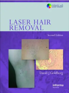 Goldberg |  Laser Hair Removal | Buch |  Sack Fachmedien