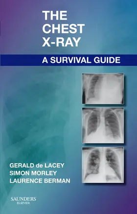 de Lacey / Morley / Berman |  The Chest X-Ray: A Survival Guide | Buch |  Sack Fachmedien