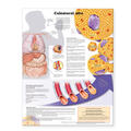  High Cholesterol Anatomical Chart in Spanish (Colesterol alto) | Sonstiges |  Sack Fachmedien