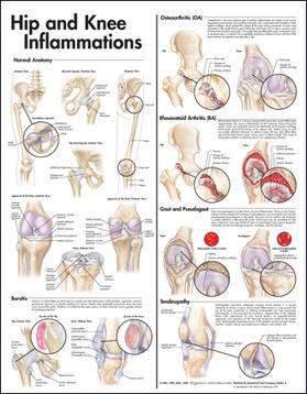 Hip and Knee Inflammations Anatomical Chart | Sonstiges | 978-0-7817-7347-8 | sack.de