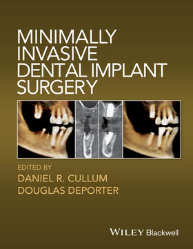 Cullum / Deporter | Minimally Invasive Dental Implant Surgery | Buch | 978-0-8138-1452-0 | sack.de