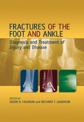 Calhoun / Laughlin |  Fractures of the Foot and Ankle | Buch |  Sack Fachmedien