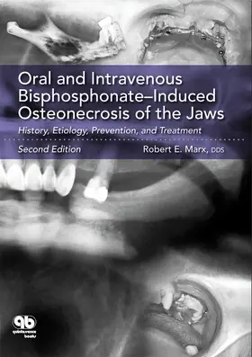Marx |  Oral and Intravenous Bisphosphonate-Induced Osteonecrosis of the Jaws | eBook | Sack Fachmedien
