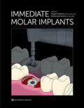 Deporter / Ketabi |  Immediate Molar Implants | Buch |  Sack Fachmedien