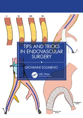 Solimeno |  Tips and Tricks in Endovascular Surgery | Buch |  Sack Fachmedien