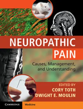 Toth / Moulin |  Neuropathic Pain | Buch |  Sack Fachmedien
