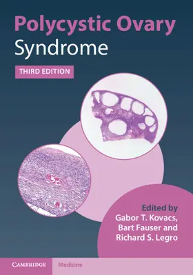 Kovacs / Fauser / Legro |  Polycystic Ovary Syndrome | Buch |  Sack Fachmedien