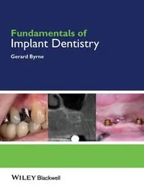 Byrne |  Fundamentals of Implant Dentistry | Buch |  Sack Fachmedien