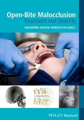 Janson / Valarelli |  Open-Bite Malocclusion | Buch |  Sack Fachmedien