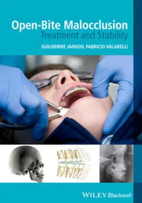 Janson / Valarelli | Open-Bite Malocclusion | E-Book | sack.de