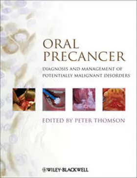 Thomson |  Oral Precancer | eBook | Sack Fachmedien