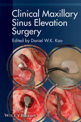 Kao | Clinical Maxillary Sinus Elevation Surgery | E-Book | www.sack.de