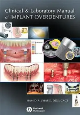 Shafie |  Clinical and Laboratory Manual of Implant Overdentures | eBook | Sack Fachmedien