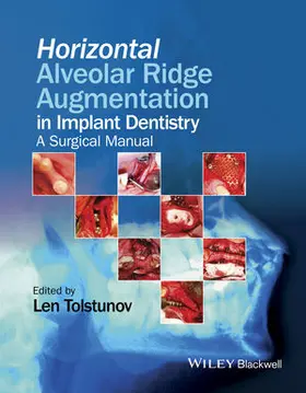 Tolstunov | Horizontal Alveolar Ridge Augmentation in Implant Dentistry | Buch | 978-1-119-01988-6 | sack.de