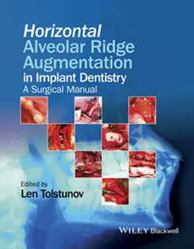Tolstunov |  Horizontal Alveolar Ridge Augmentation in Implant Dentistry | eBook | Sack Fachmedien