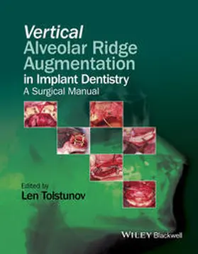 Tolstunov |  Vertical Alveolar Ridge Augmentation in Implant Dentistry | eBook | Sack Fachmedien