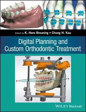 Breuning / Kau |  Digital Planning and Custom Orthodontic Treatment | Buch |  Sack Fachmedien