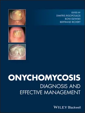 Rigopoulos / Elewski / Richert |  Onychomycosis | Buch |  Sack Fachmedien