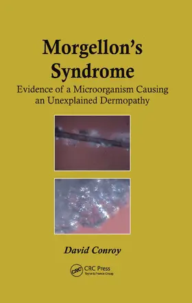 Conroy |  Morgellon's Syndrome | Buch |  Sack Fachmedien