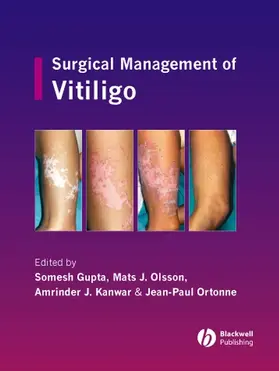 Gupta / Olsson / Kanwar |  Surgical Management of Vitiligo | Buch |  Sack Fachmedien