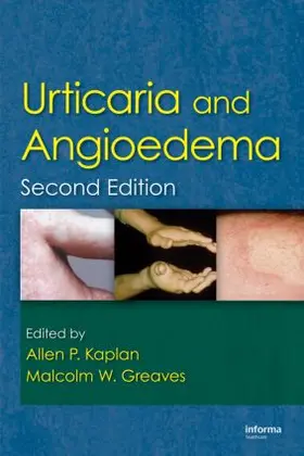Kaplan / Greaves |  Urticaria and Angioedema | Buch |  Sack Fachmedien