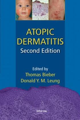 Bieber / Leung | Atopic Dermatitis | Buch | 978-1-4200-7798-8 | sack.de