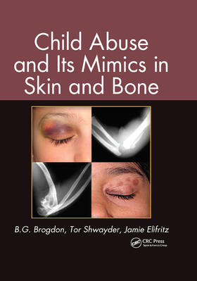 Brogdon / Elifritz / Shwayder |  Child Abuse and its Mimics in Skin and Bone | Buch |  Sack Fachmedien
