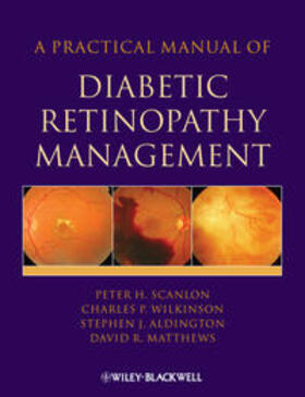 Scanlon / Aldington / Wilkinson | A Practical Manual of Diabetic Retinopathy Management | E-Book | sack.de