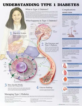Anatomical Chart Company / Unger |  Understanding Type 1 Diabetes Anatomical Chart | Sonstiges |  Sack Fachmedien