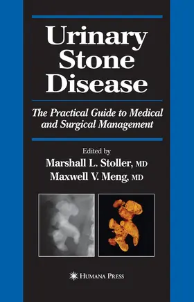 Stoller / Meng |  Urinary Stone Disease | Buch |  Sack Fachmedien