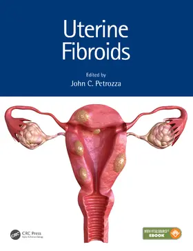 Petrozza | Uterine Fibroids | Buch | 978-1-4987-3920-7 | www.sack.de