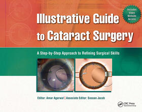 Agarwal | Illustrative Guide to Cataract Surgery | Buch | 978-1-55642-981-1 | sack.de