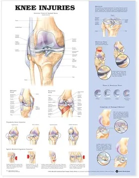  Knee Injuries Anatomical Chart | Buch |  Sack Fachmedien