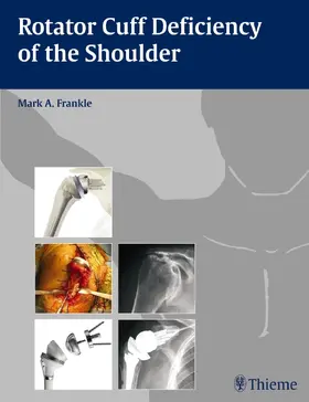 Frankle | Rotator Cuff Deficiency of the Shoulder | Buch | 978-1-58890-506-2 | www.sack.de
