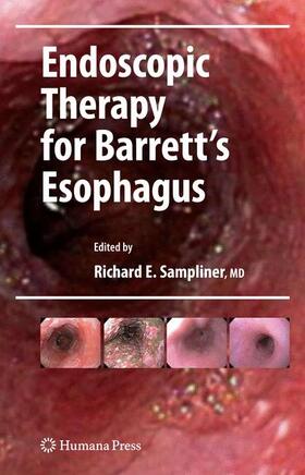 Sampliner |  Endoscopic Therapy for Barrett's Esophagus | Buch |  Sack Fachmedien