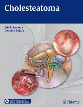 Smouha / Bojrab |  Cholesteatoma | eBook | Sack Fachmedien