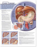  Understanding Liver Cancer Anatomical Chart | Sonstiges |  Sack Fachmedien