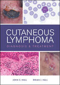 Hall |  Cutaneous Lymphoma Diagnosis and Treatment | Buch |  Sack Fachmedien