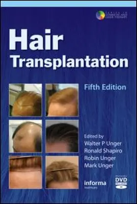 Unger / Shapiro | Hair Transplantation | Buch | 978-1-61631-006-6 | www.sack.de