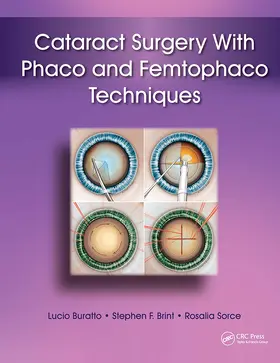 Buratto / Brint / Sorce |  Cataract Surgery With Phaco and Femtophaco Techniques | Buch |  Sack Fachmedien