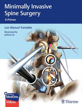 Tumialan | Minimally Invasive Spine Surgery | Medienkombination | 978-1-62623-218-1 | sack.de